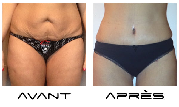 Abdominoplastie Tunisie avant apres