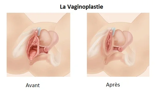Résultats  Vaginoplastie Tunisie