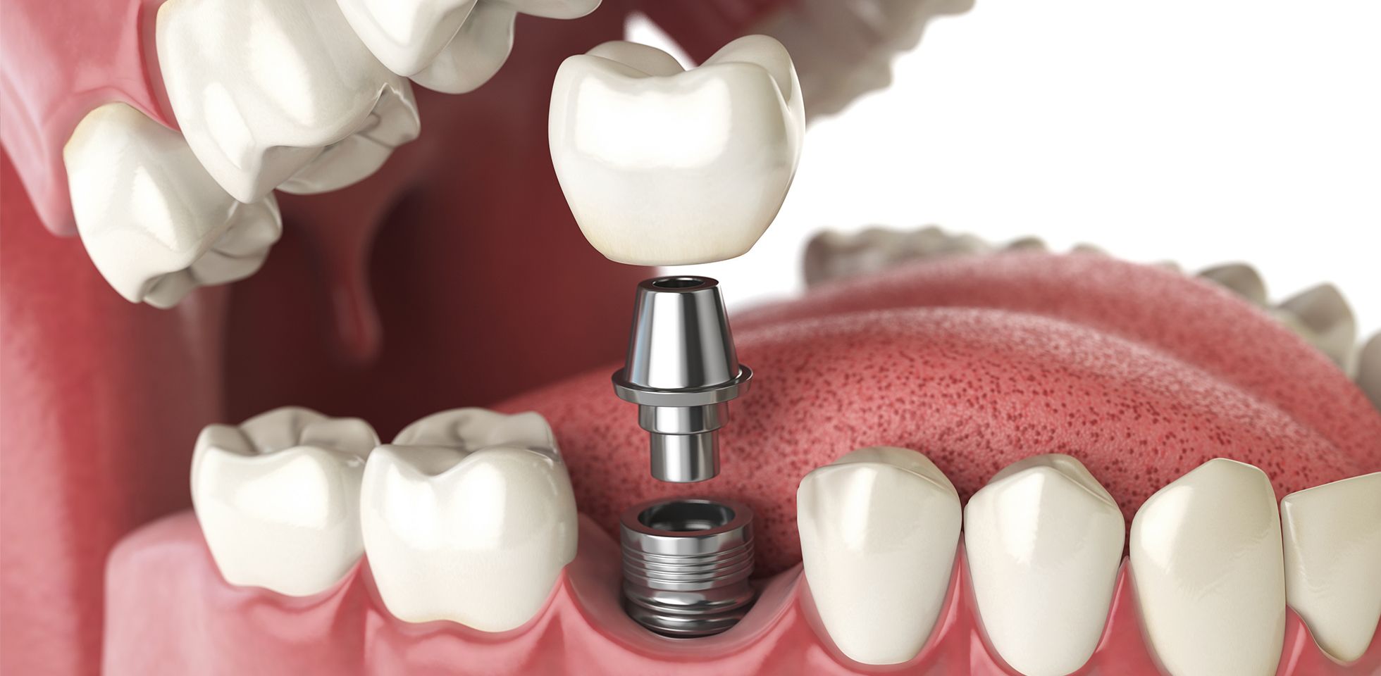Pose d’implants dentaires