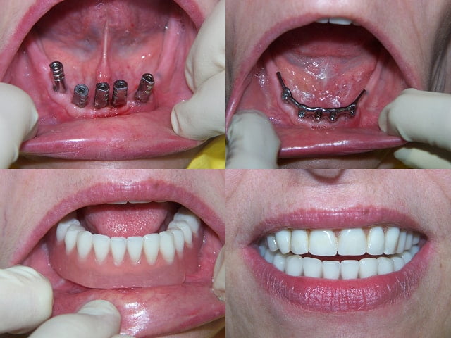 implant-dentaire.jpg
