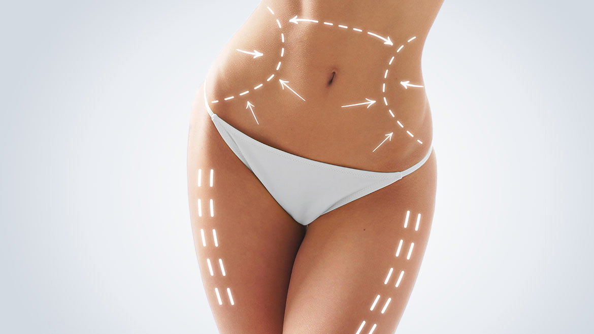 En-quoi-consiste-la-liposuccion.jpg