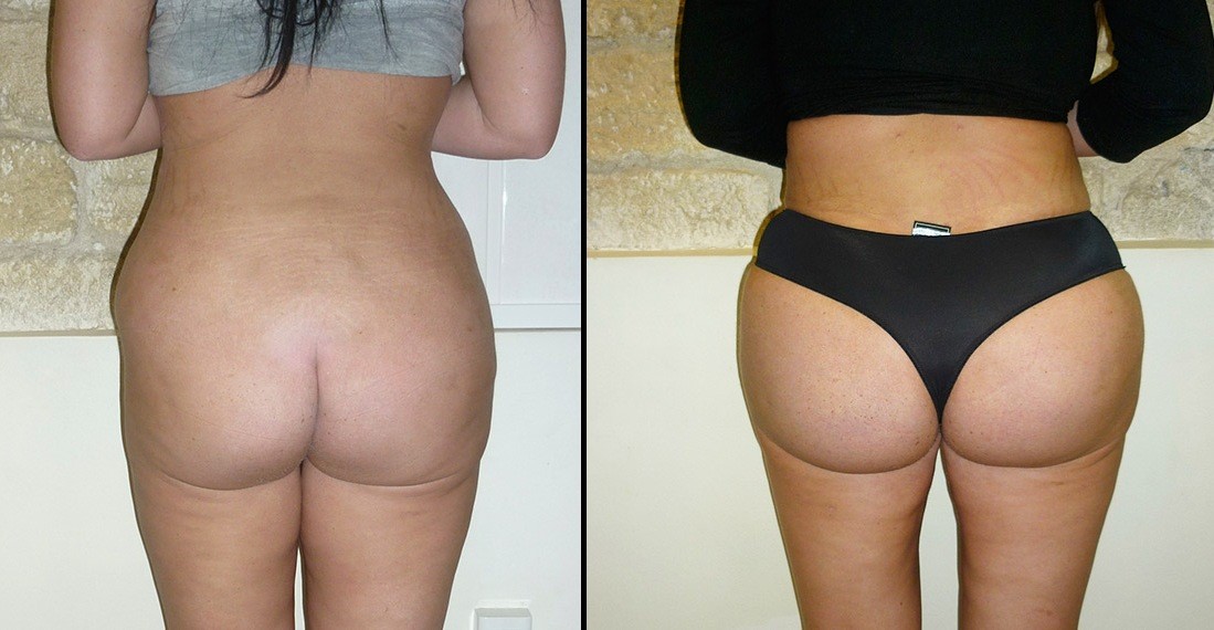 Augmentation des fesses avant apres