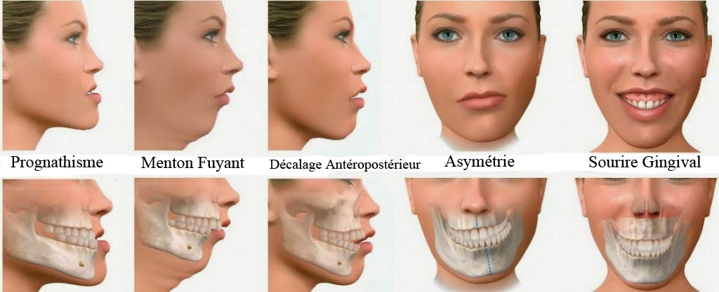 chirurgie esthétique du menton en Tunisie