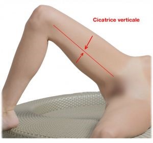 technique verticale lifting des cuisses