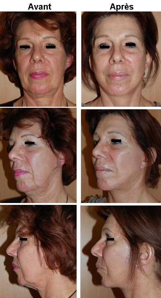 Lifting Cervico-Facial avant apres