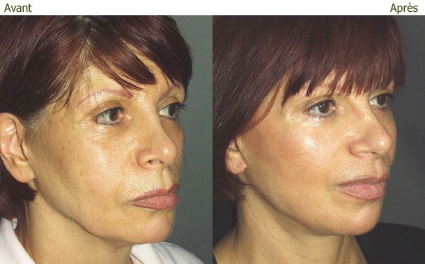 Lifting Cervico-Facial