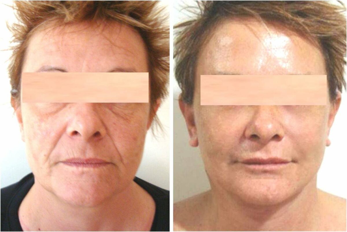 lipofilling-visage-avant-apres