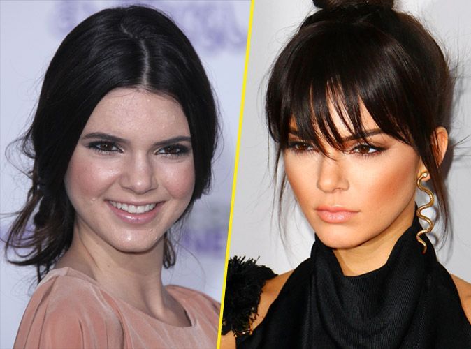 Kendall Jenner et la chirurgie esthétique