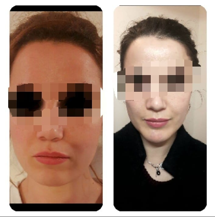 Rhinoplastie En Tunisie