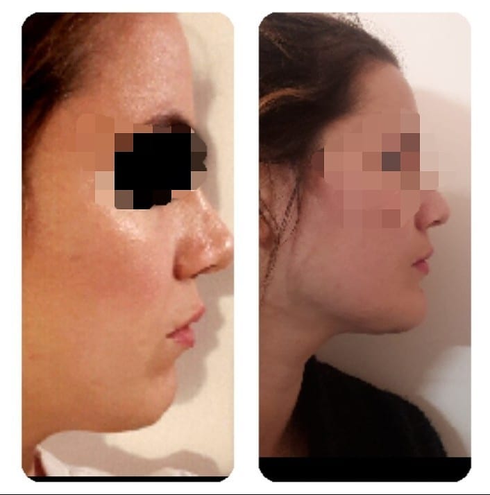 Rhinoplastie En Tunisie