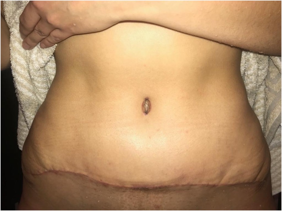 Abdominoplastie En Tunisie