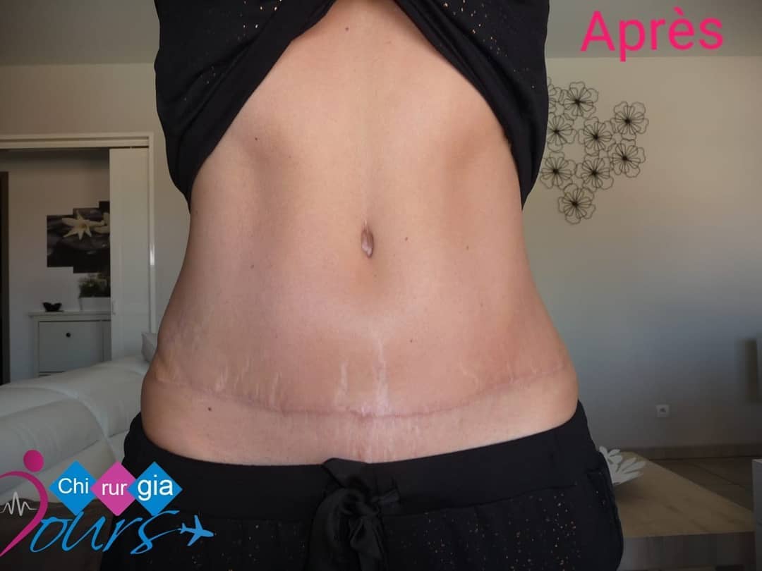 abdominoplastie après