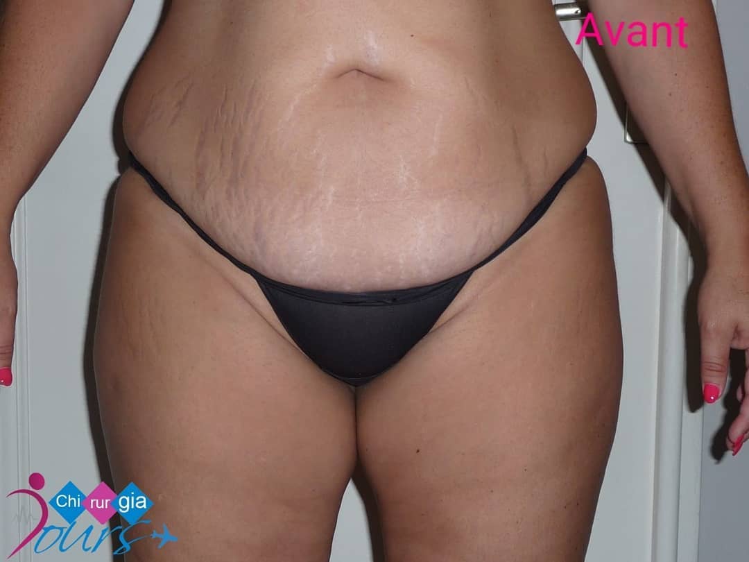 abdominoplastie avant