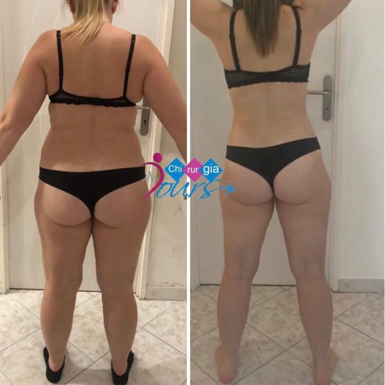 liposuccion avant après