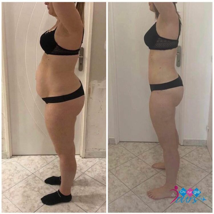 liposuccion avant après