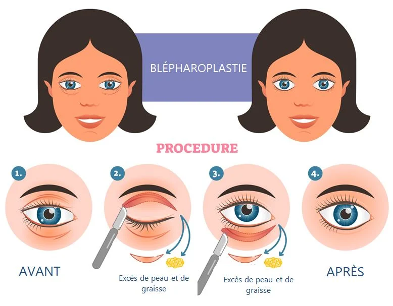 blépharoplastie