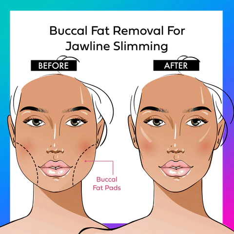 Buccal Fat Removal : Qu’est-ce que c’est