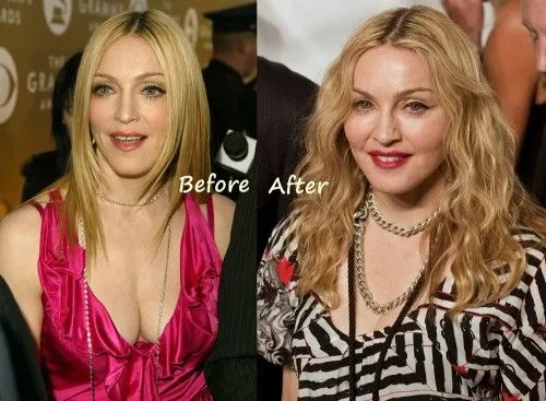 Madonna et la chirurgie esthétique avant apres