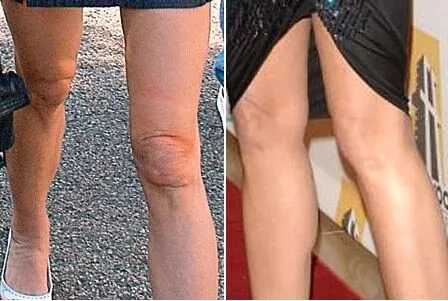 Les genoux de Demi Moore avant et après la chirurgie esthétique