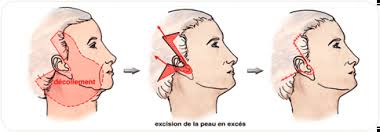 lifting facial
