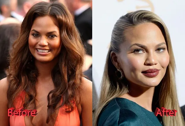 Chirurgie esthétique du visage Chrissy Teigen 