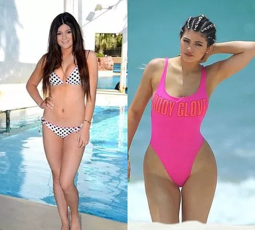 Kylie Jenner : avant /après chirurgie du corps