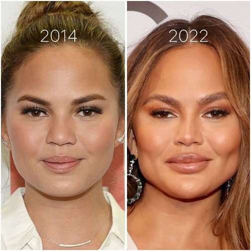 Chrissy Teigen a admis sa bichectomie dans une story