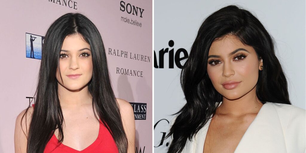 Kylie Jenner : avant /après chirurgie visage 