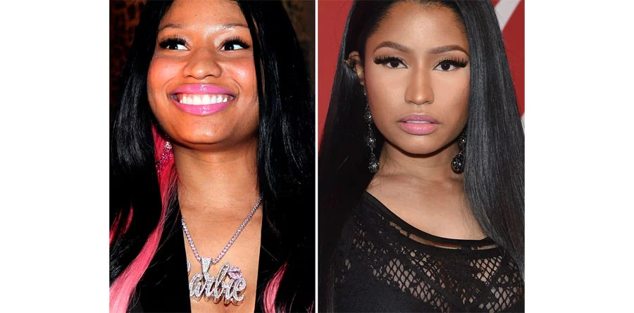 Nicki Minaj avant après chirurgie esthétique