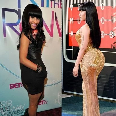 Nicki Minaj avant après lipofilling des fesses
