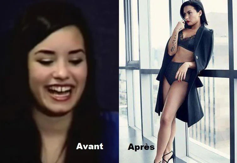Demi Lovato avant apres chirurgie esthetique