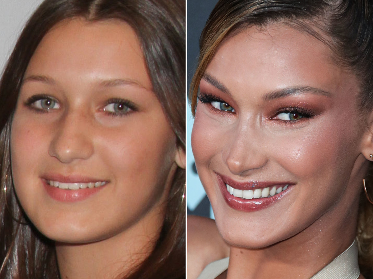 Bella Hadid avant et après rhinoplastie