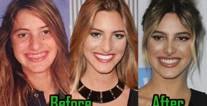 Lele Pons avant après la chirurgie esthétique 