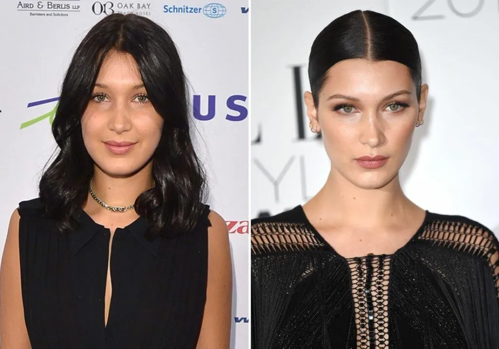 Bella Hadid chirurgie esthétique avant après