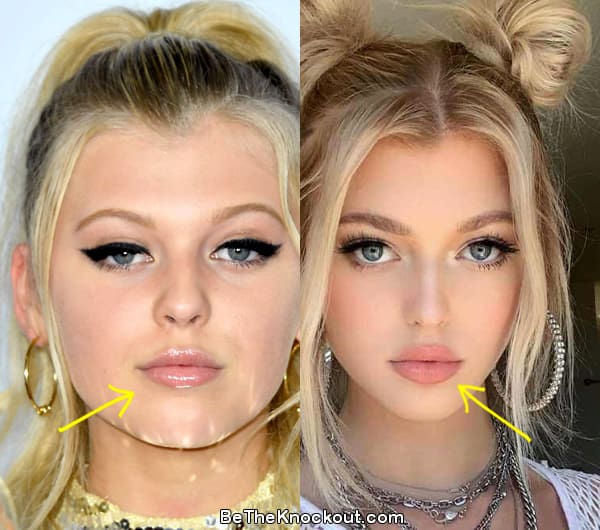 Loren Gray avant/après 