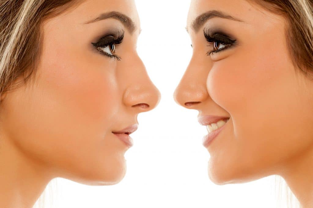 Quel est le prix d’une rhinoplastie ?