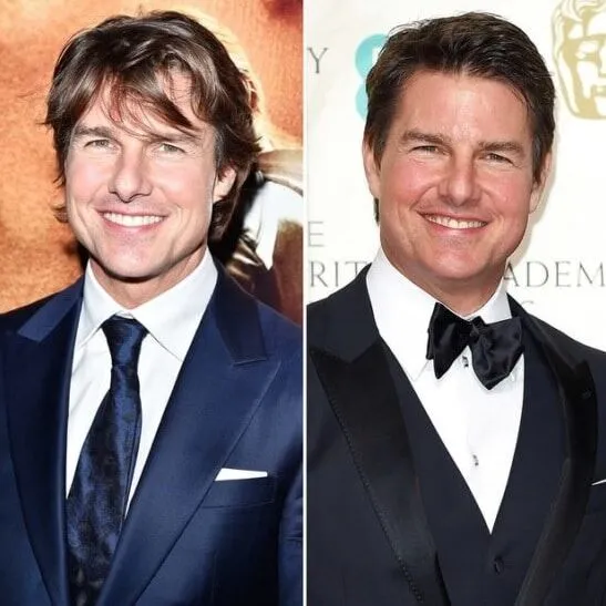 Photo en 2015 / Tom Cruise après chirurgie plastique en 2016