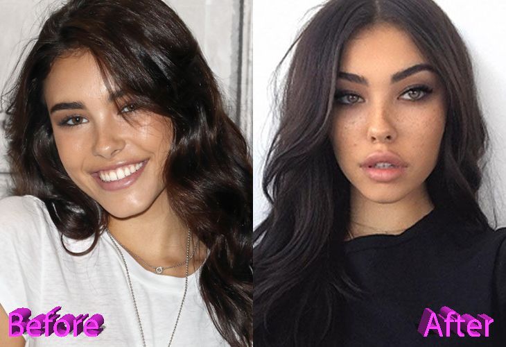 Madison Beer avant apres la chirurgie esthetique