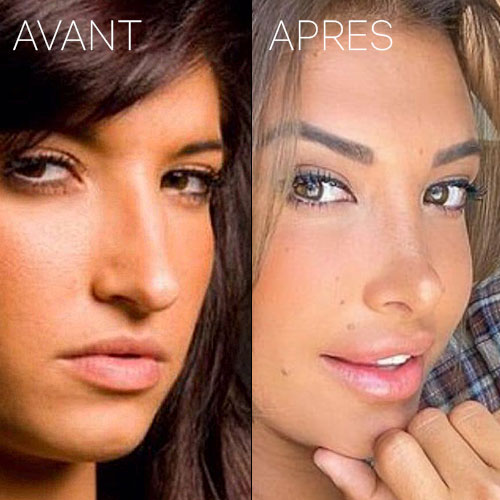 Le visage de Mélanie Dedigama avant et après sa chirurgie esthétique du nez