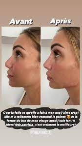 Avant/ Après de la rhinoplastie de Léa Mary