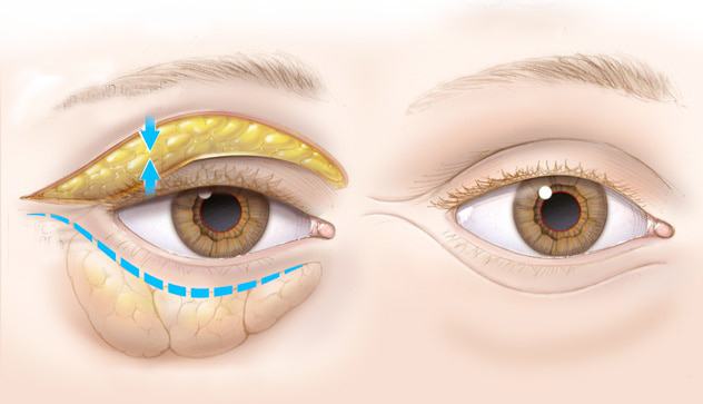 le prix d'une blépharoplastie 