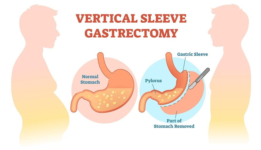 prix d'une sleeve gastrique