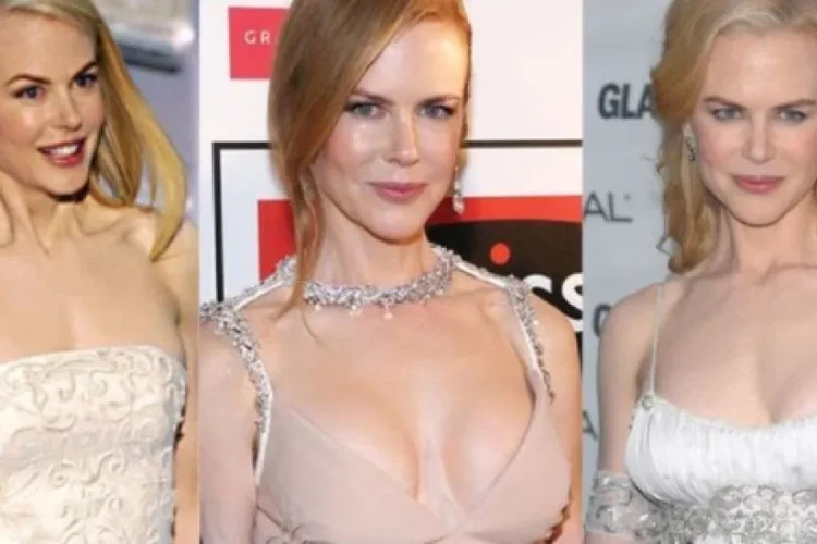 nicole kidman chirurgie esthetique