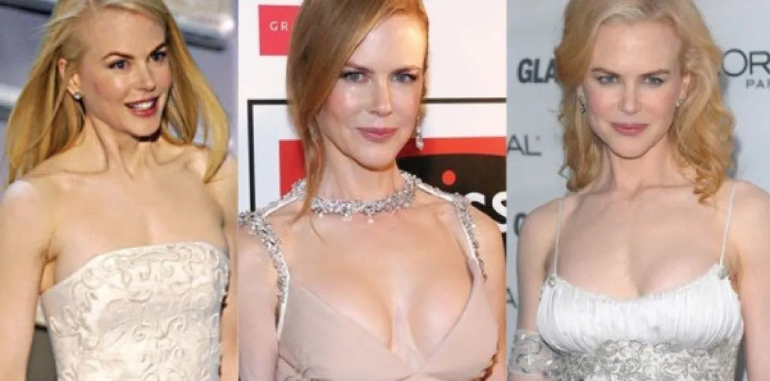 nicole kidman chirurgie esthetique