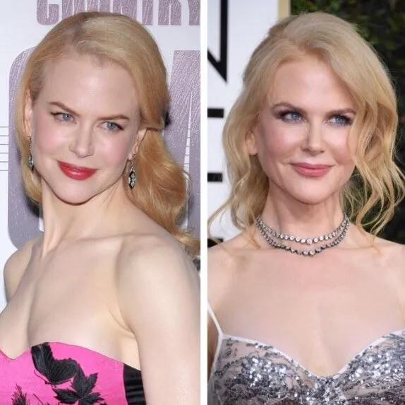 nicole-kidman-chirurgie-esthetique