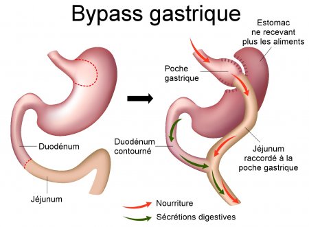 prix d'un bypass gastrique