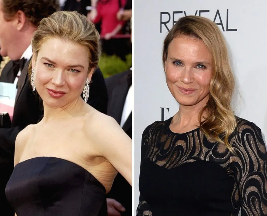 Renée Zellweger : Photo avant/après la chirurgie esthétique