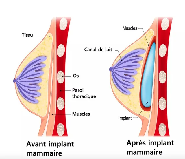 L’augmentation mammaire par pose d’implants