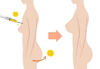 L’augmentation mammaire par lipofilling