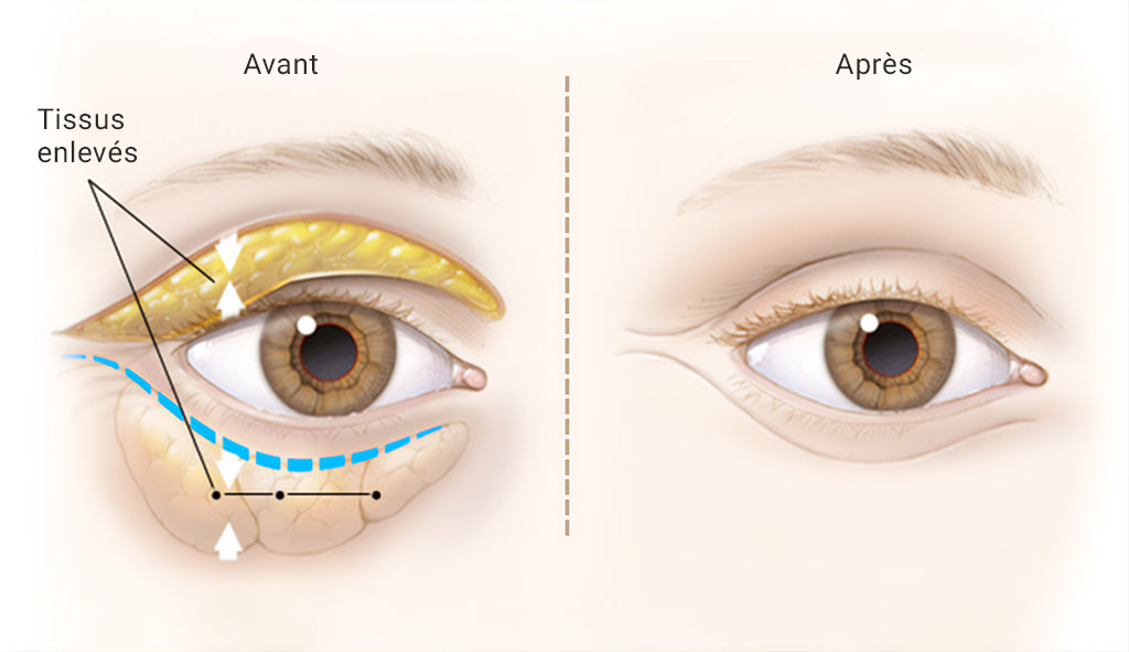 Chirurgie des paupières